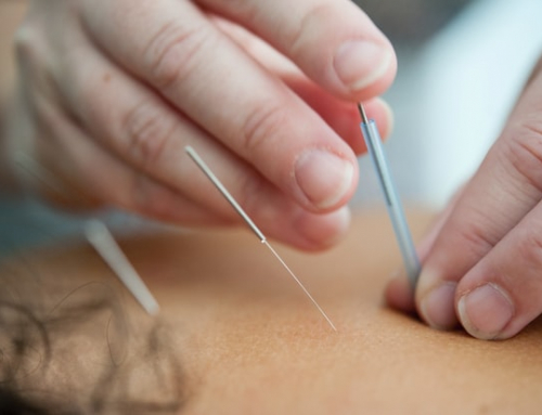 What is acupuncture in Toowoomba and how can it help you?