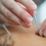 What is acupuncture in Toowoomba and how can it help you